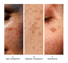 Skin Concerns