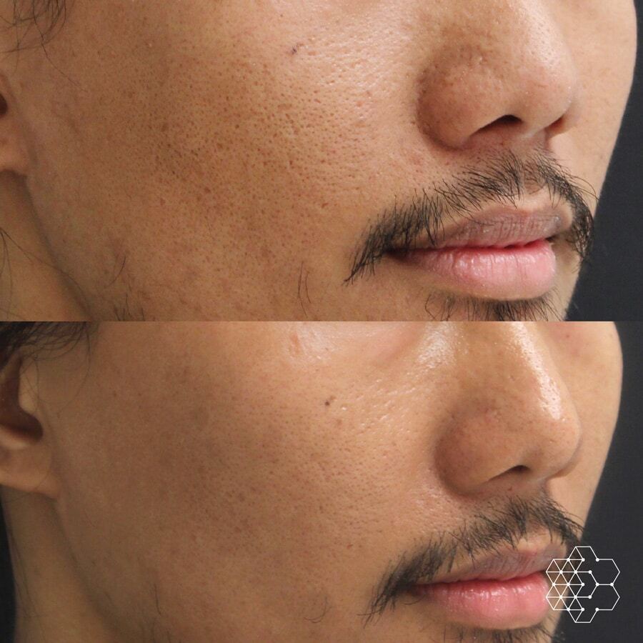 Enlarged Pore Treatments Vancouver Enlarged Pore Treatments Vancouver