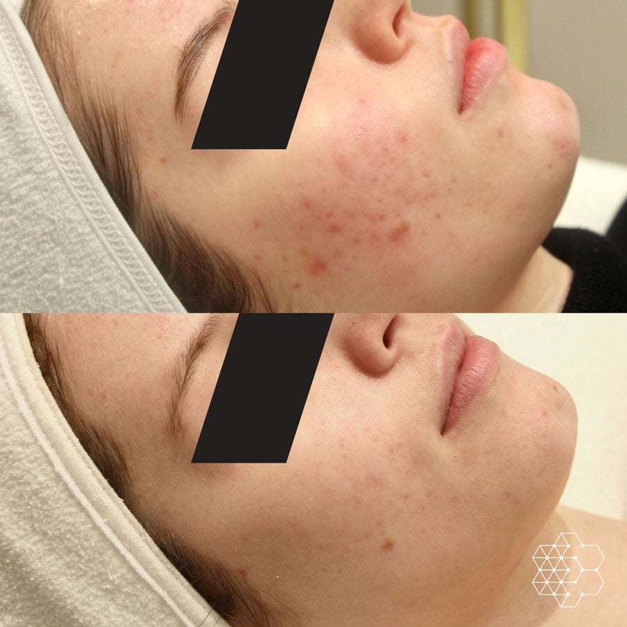 Acne Treatment in Vancouver Acne Treatment in Vancouver