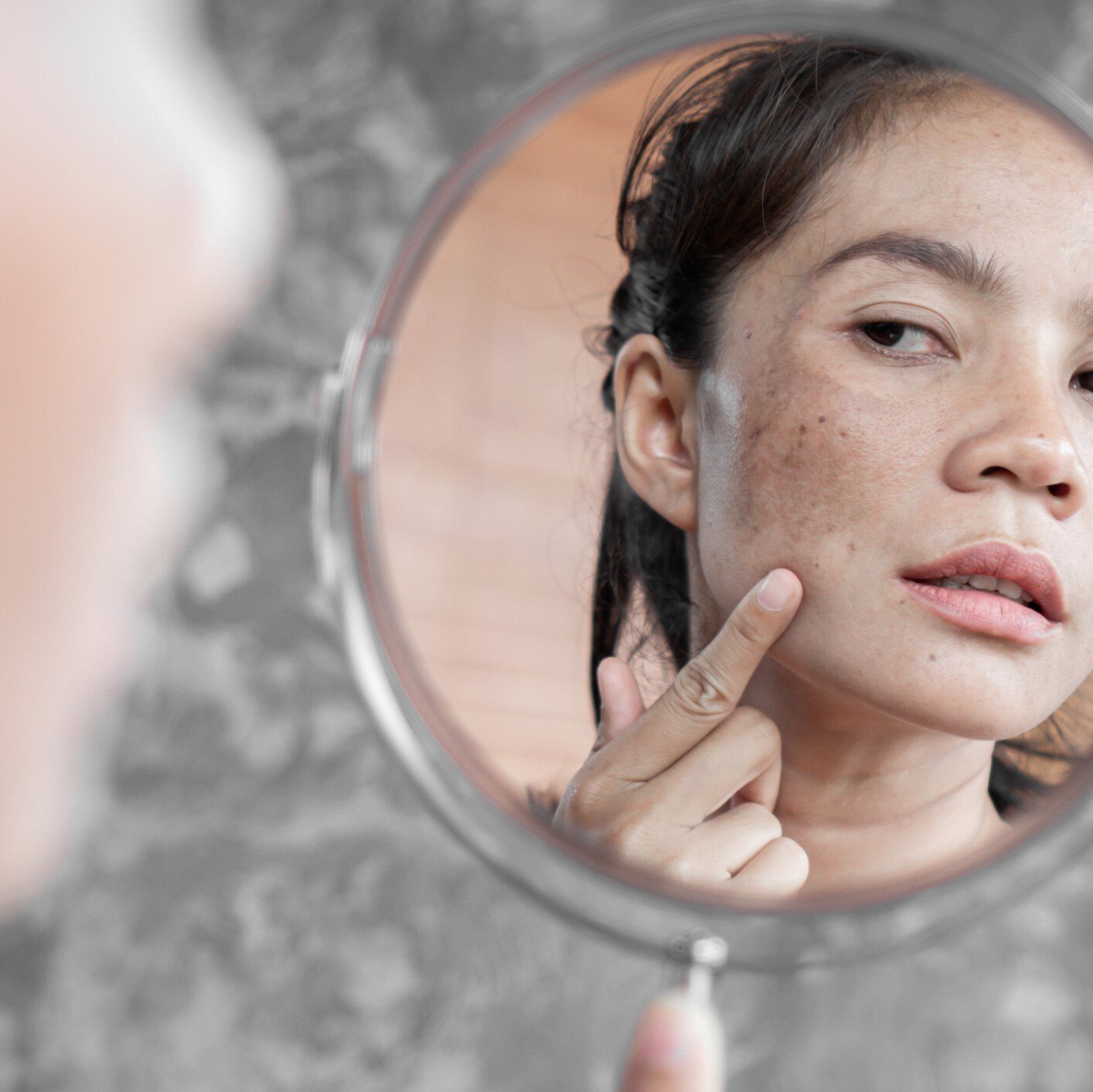Freckle & Brown Spot Treatment in Vancouver Freckle & Brown Spot Treatment in Vancouver