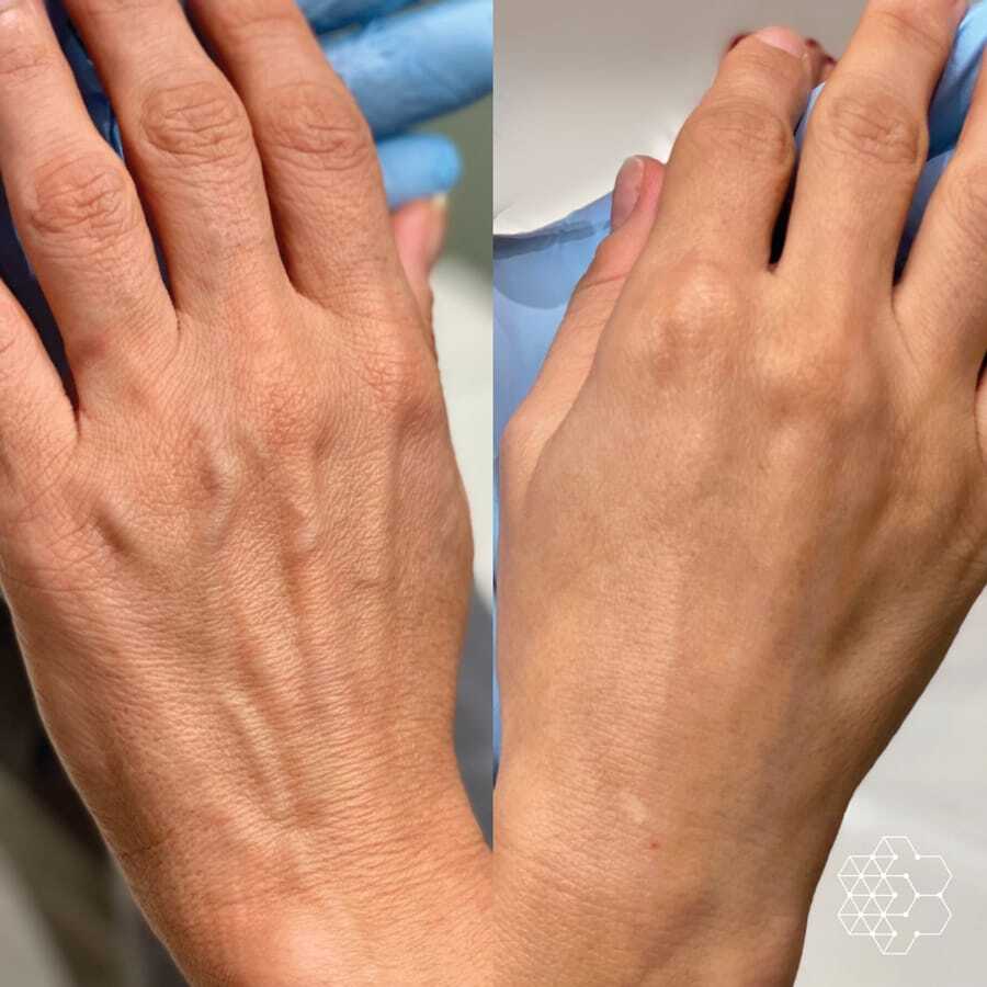 Radiesse hand filler Radiesse hand filler