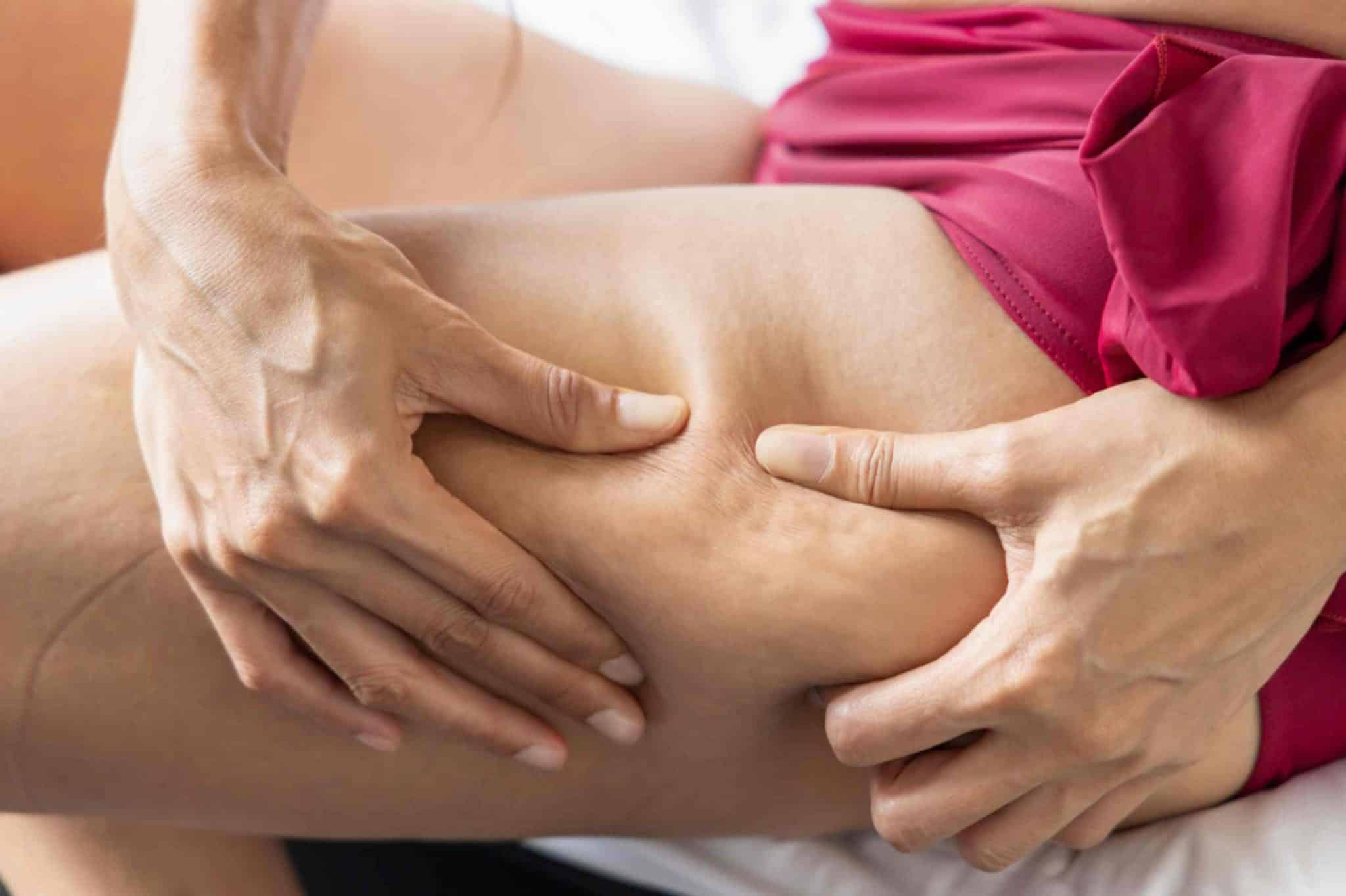 Signs of Cellulite Signs of Cellulite
