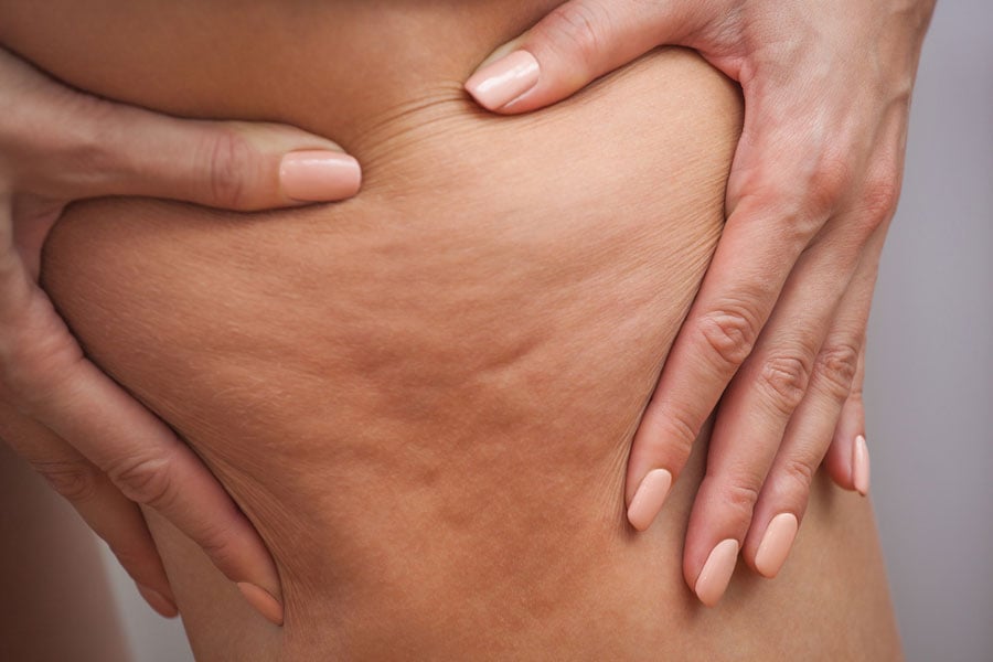 Cellulite Treatment in Vancouver Cellulite Treatment in Vancouver