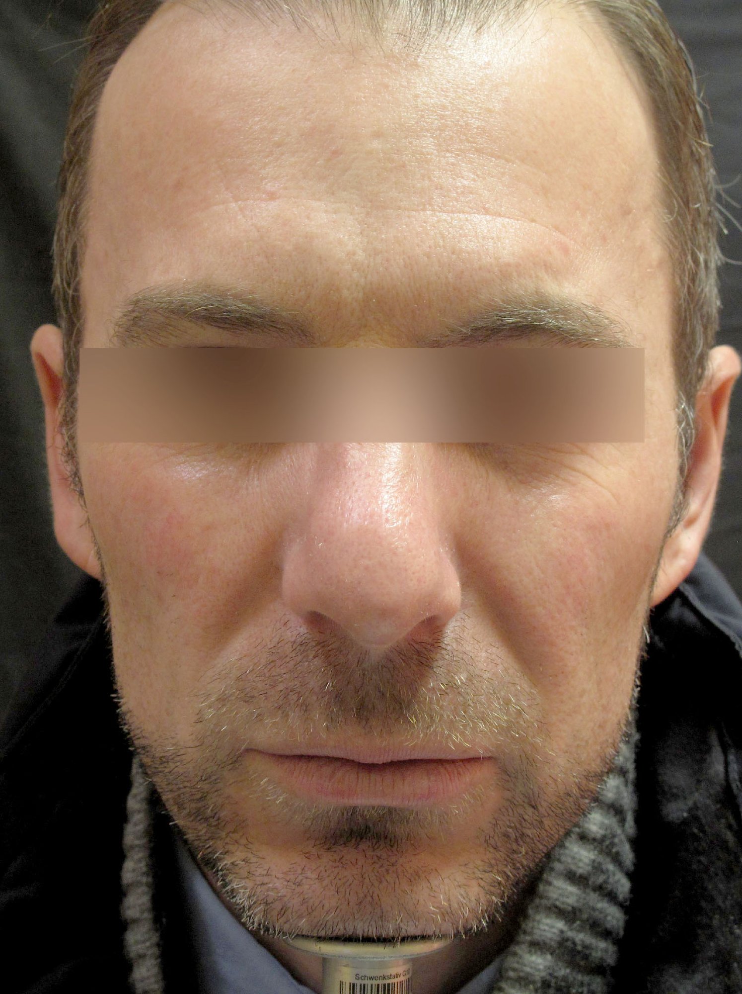 Frown Lines Correction Frown Lines Correction
