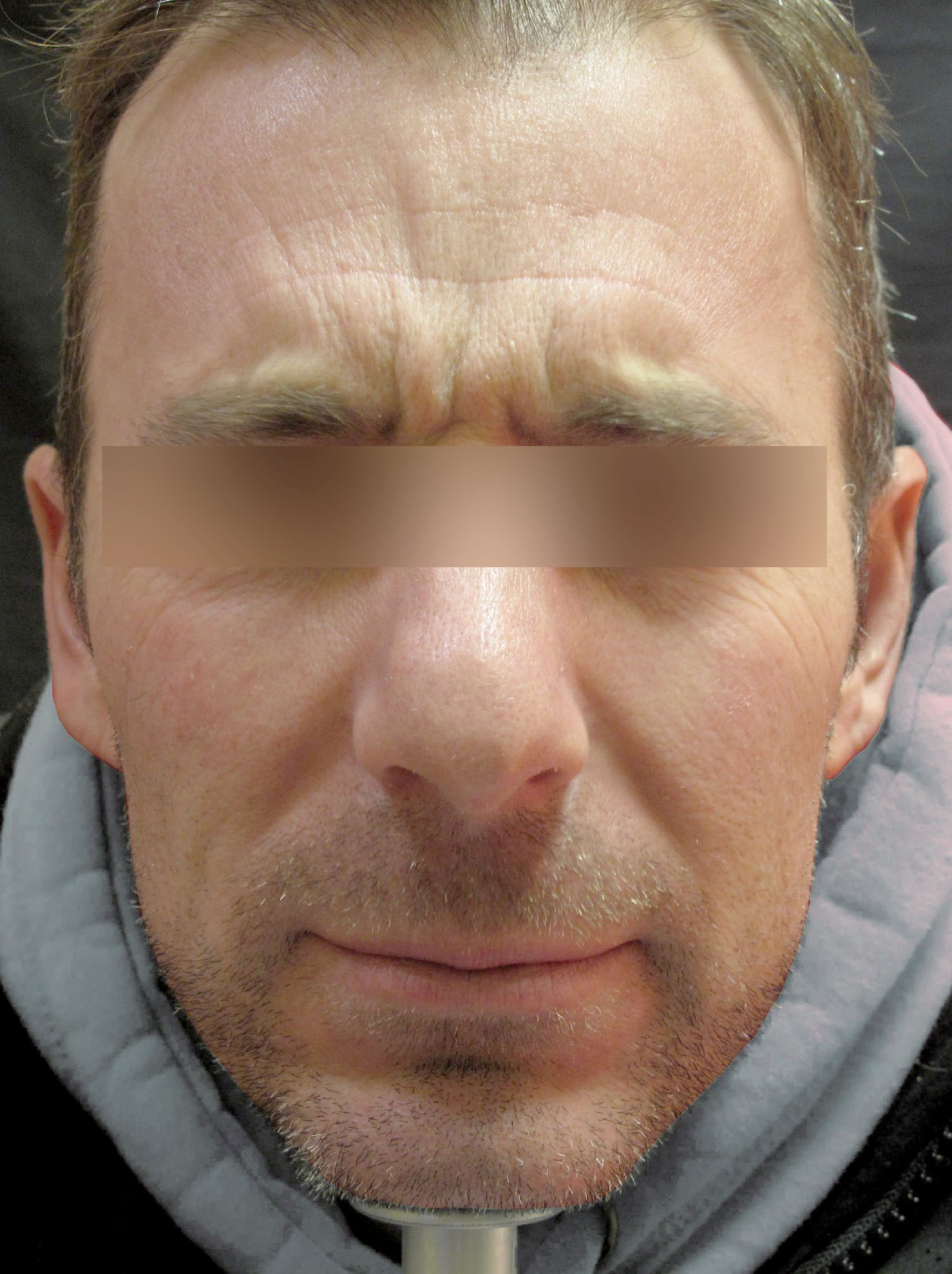Frown Lines Correction Frown Lines Correction