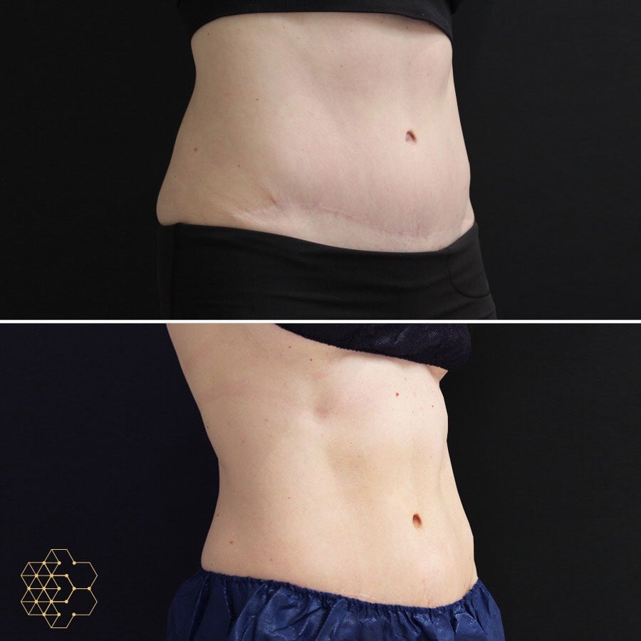Stubborn Fat Treatments in Vancouver