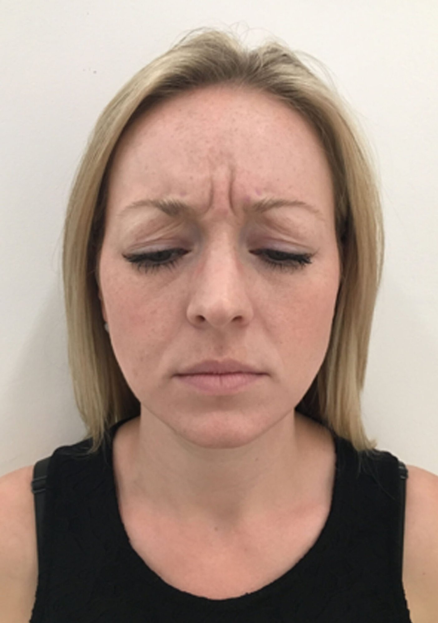 Botox