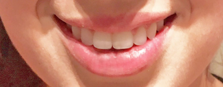 Gummy Smile