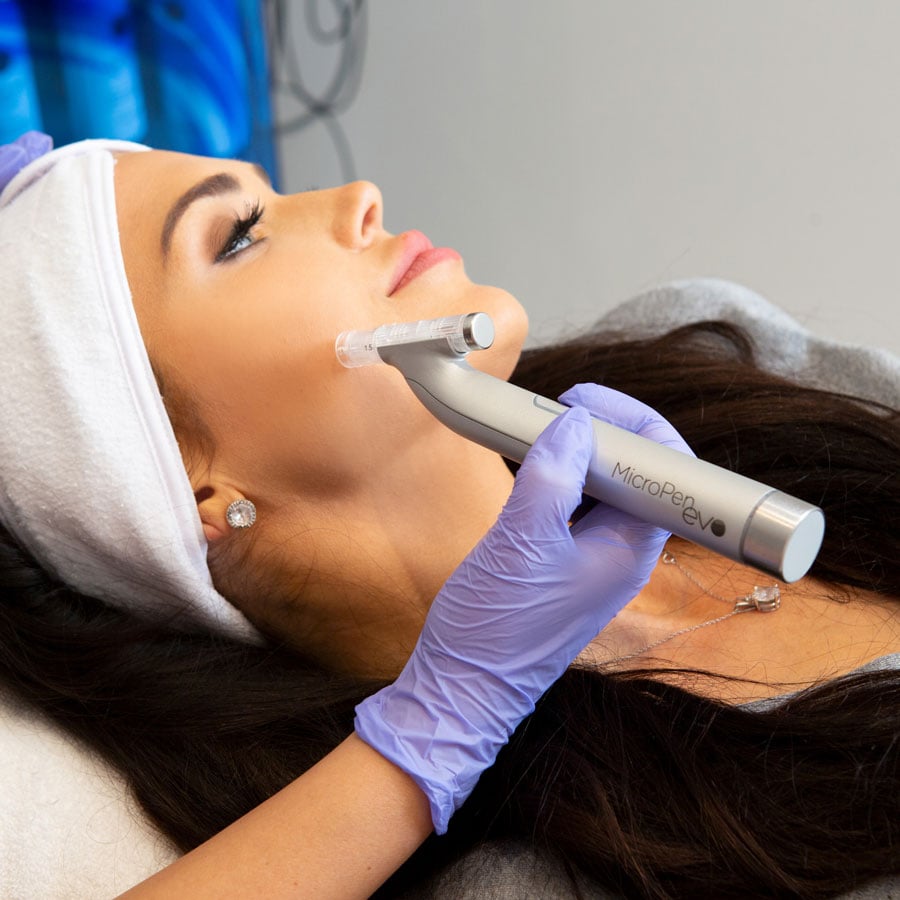 Microneedling