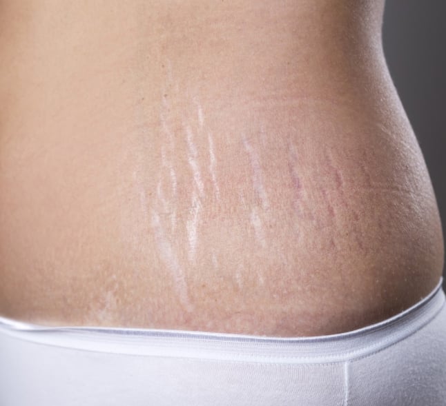 Stretch Mark Removal in Vancouver Stretch Mark Removal in Vancouver