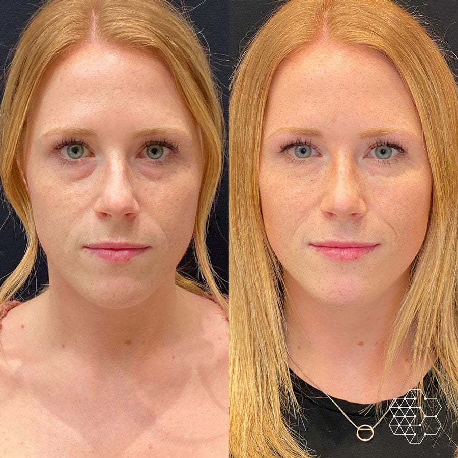 Tired Eye Treatments in Vancouver Tired Eye Treatments in Vancouver