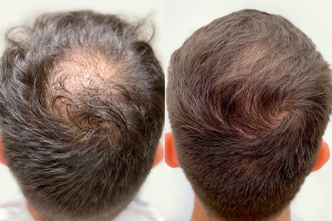 Before and After Result