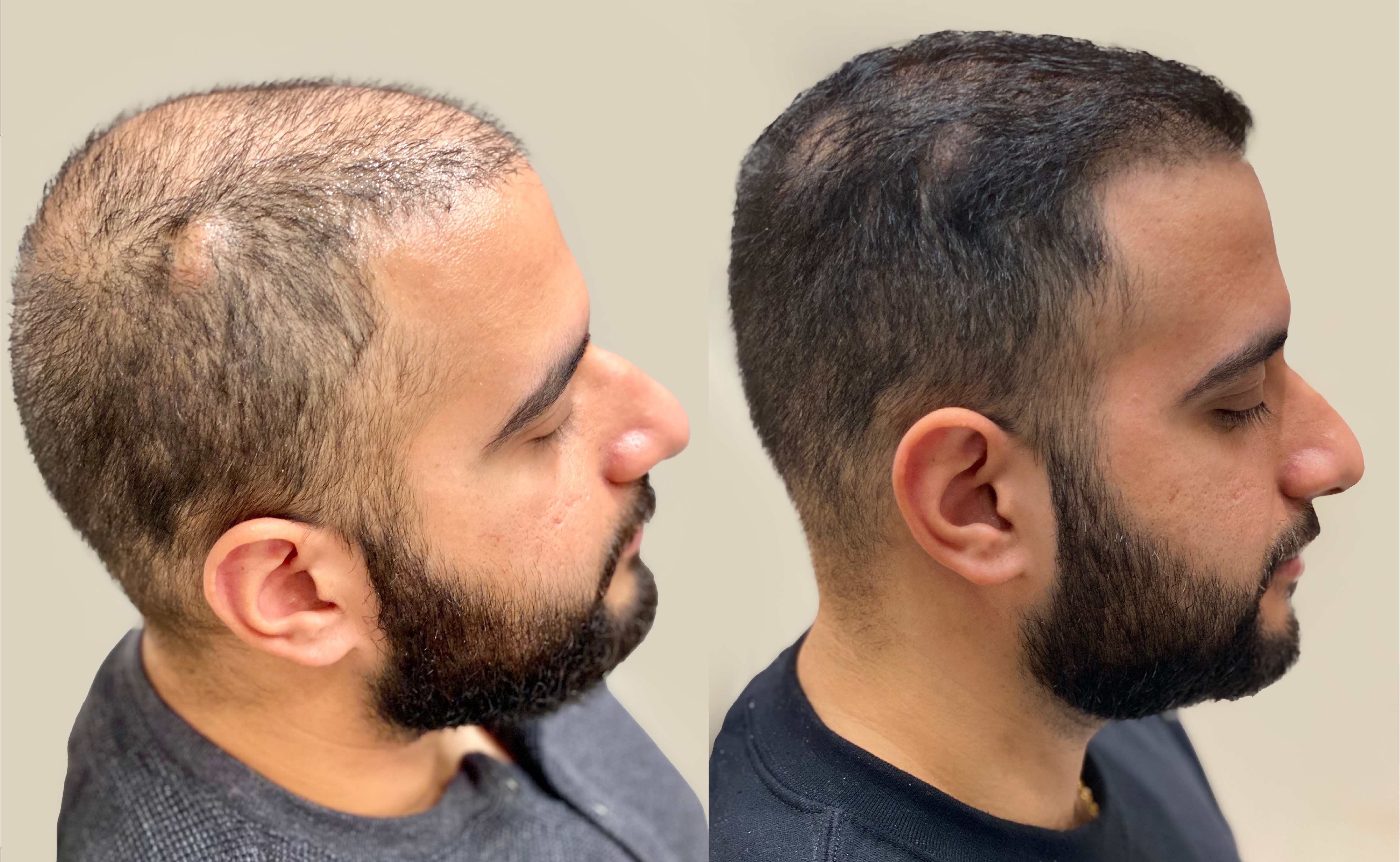 Before and After Result