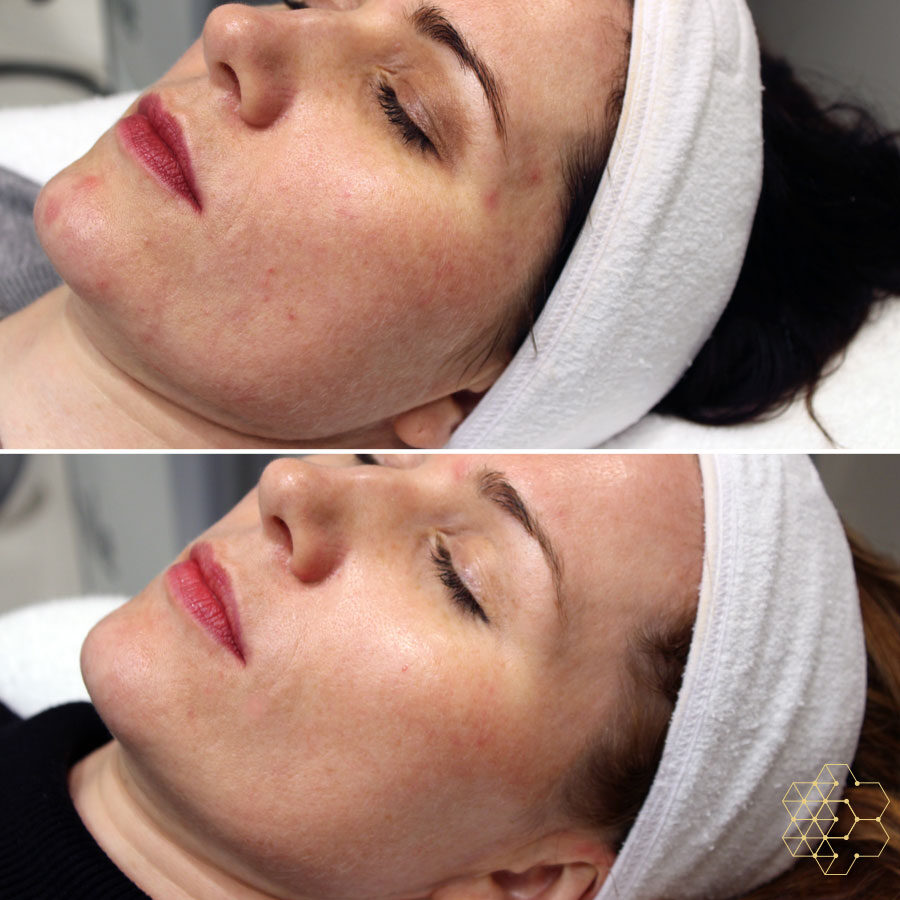 Forever Bare BBL™ (Laser Hair Removal) Forever Bare BBL™ (Laser Hair Removal)