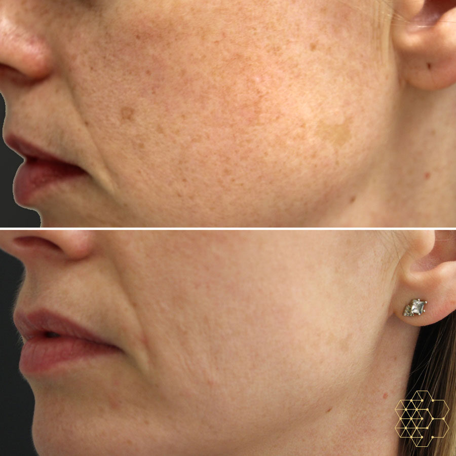 Skin Technique for IPL Treatments Skin Technique for IPL Treatments
