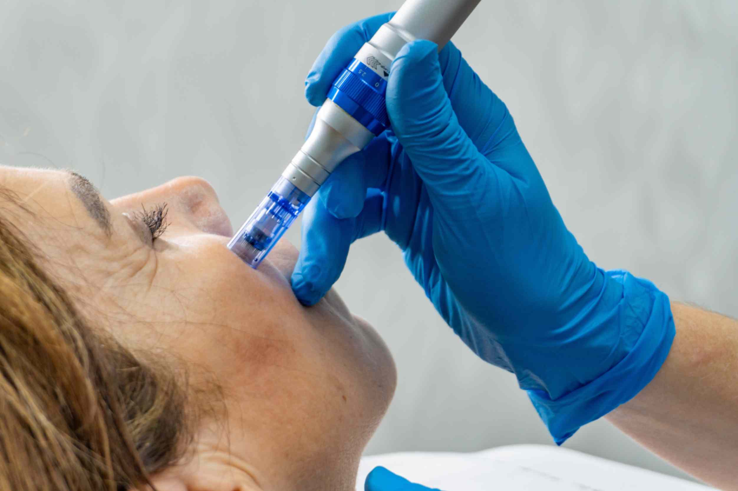 Understanding Different Types Of Microneedling Treatments