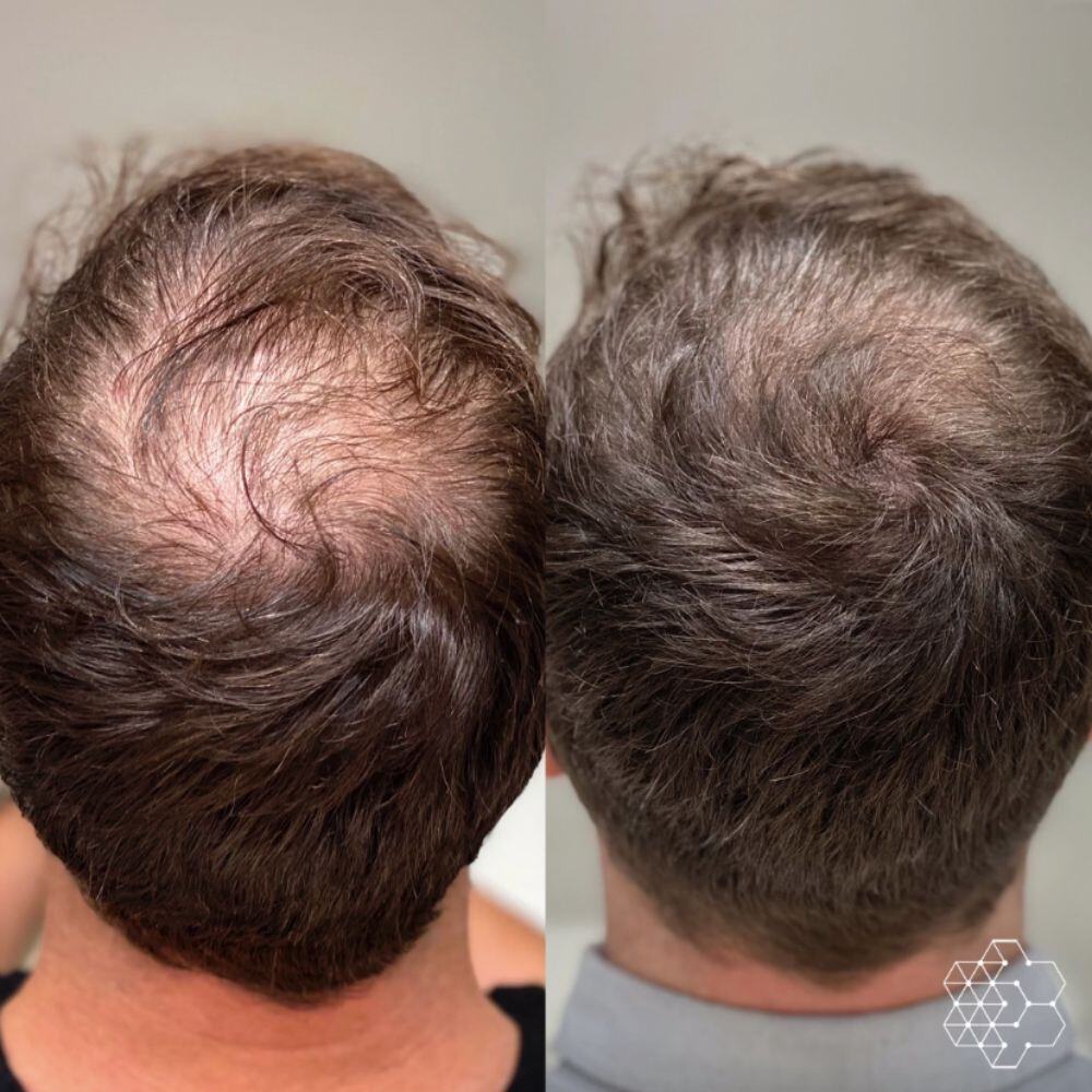How to Regrow Thinning Hair