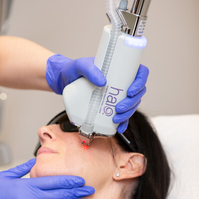 How HALO® Laser Can Benefit Your Skin: Skin Technique’s Guide 