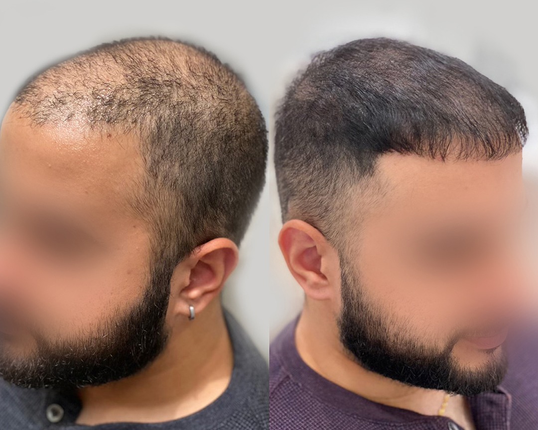 Before and After Result