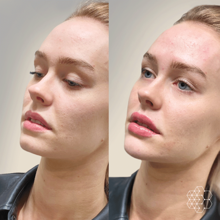 Chin Enhancement