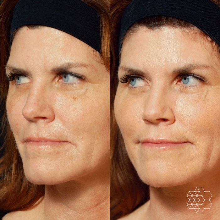 Liquid Face Lift