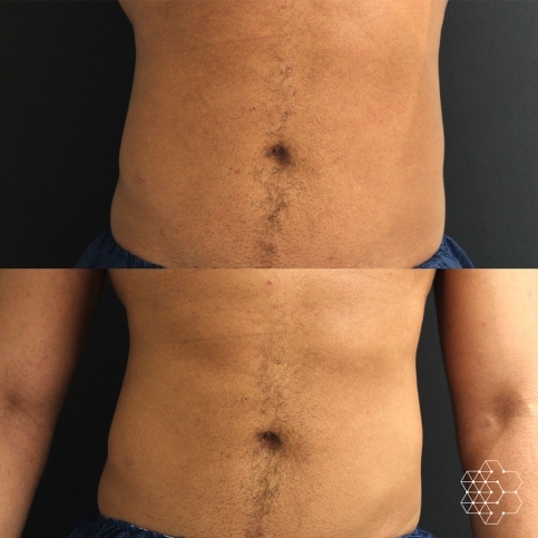 Emsculpt