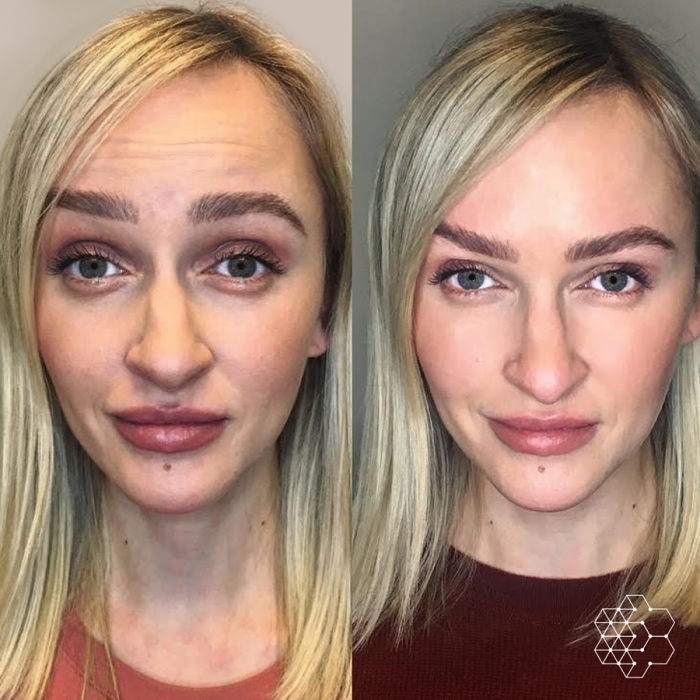Forehead Lines