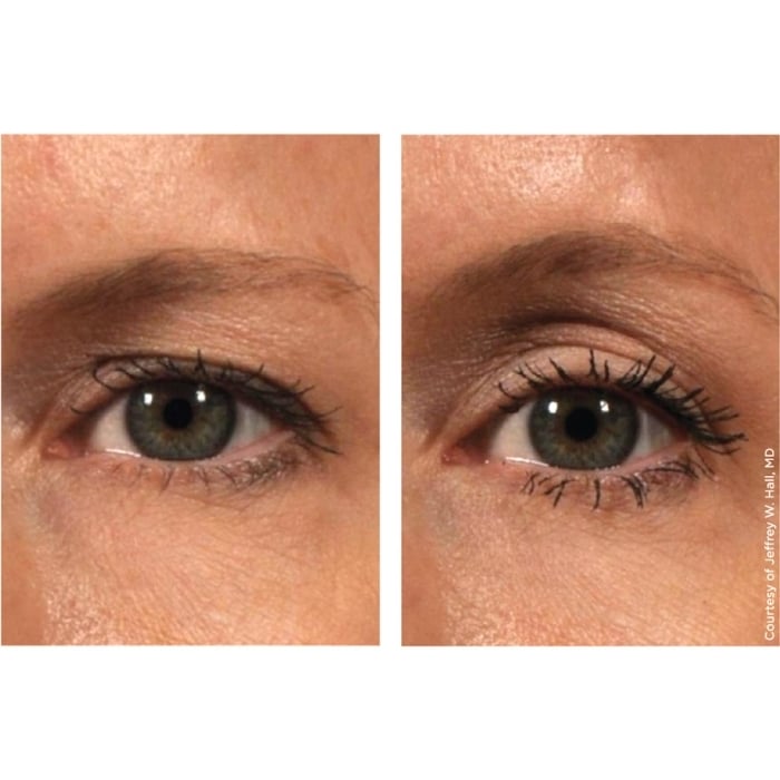 Ultherapy®