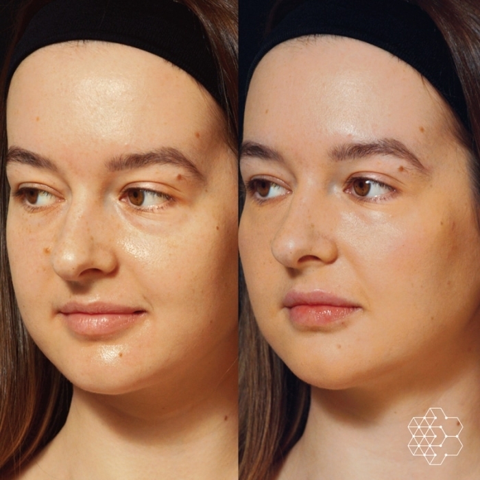 Liquid Face Lift