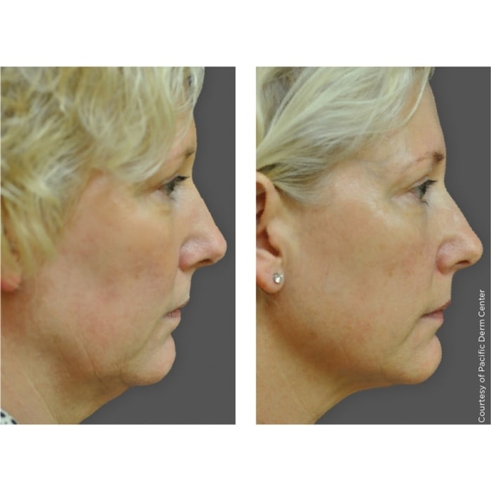 Ultherapy®