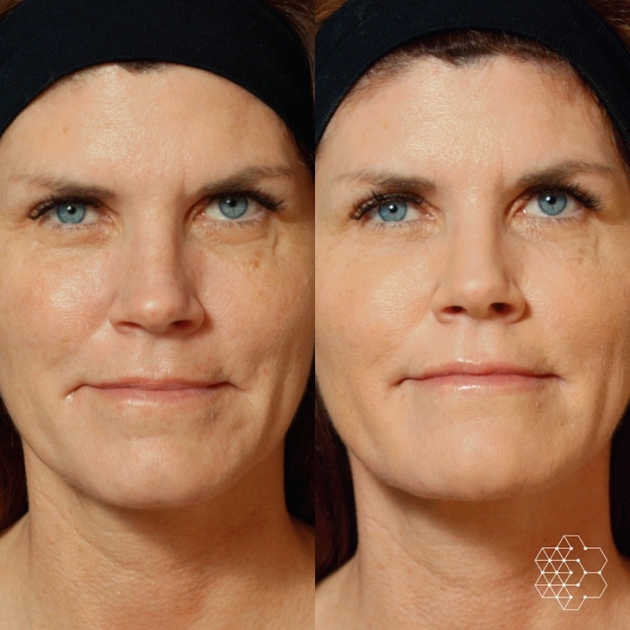 Liquid Face Lift