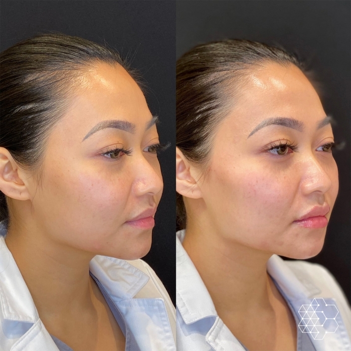 Cheek Enhancement
