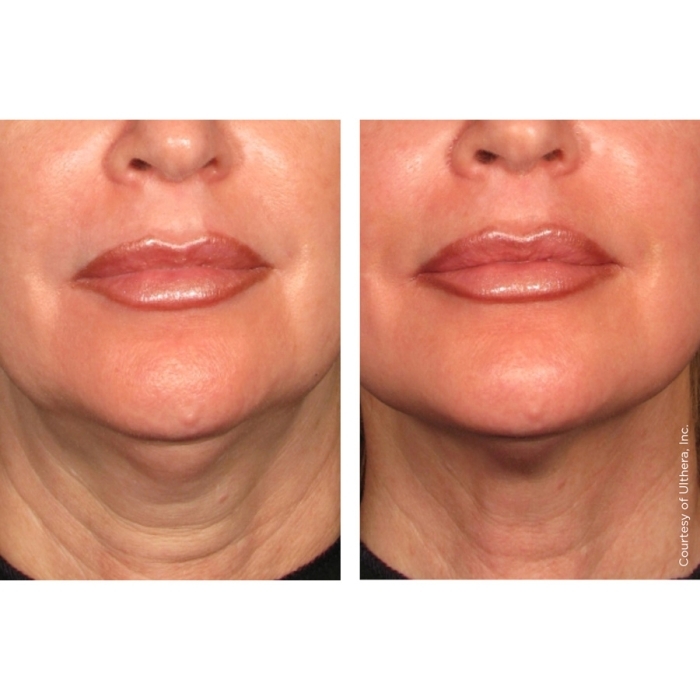 Ultherapy®