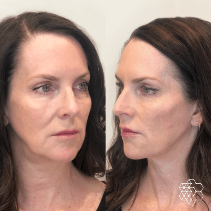 Liquid Face Lift