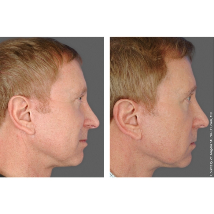 Ultherapy®