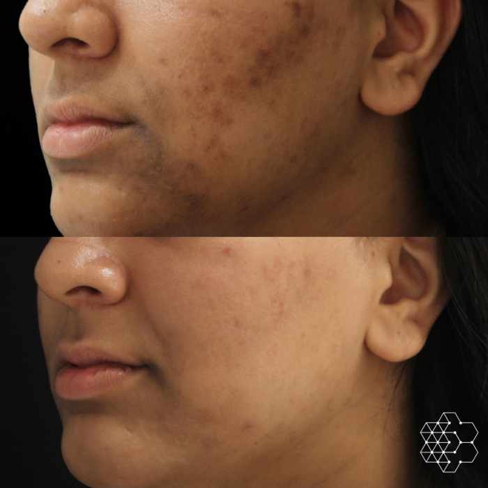 Chemical Peel
