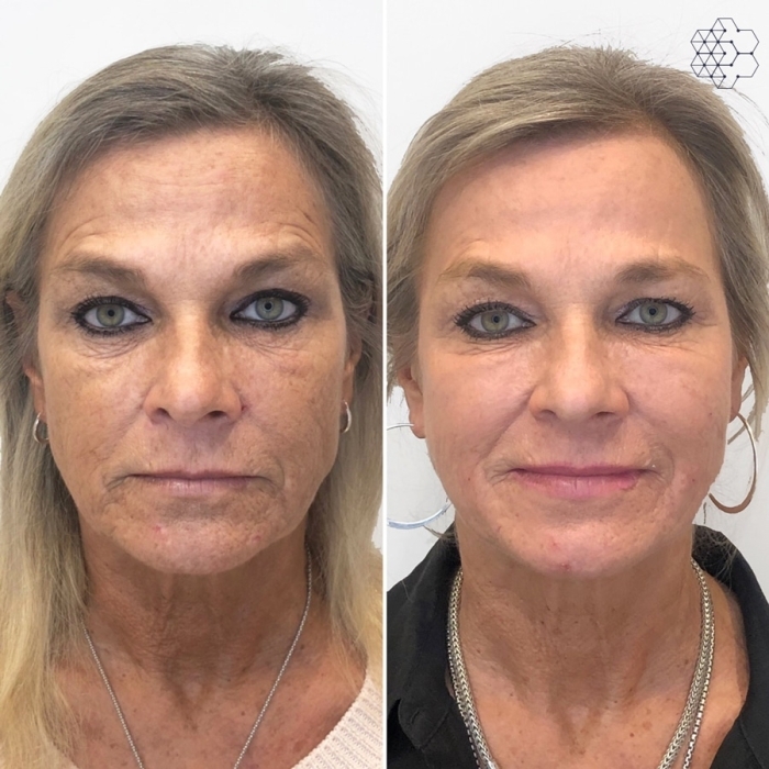 Sculptra®
