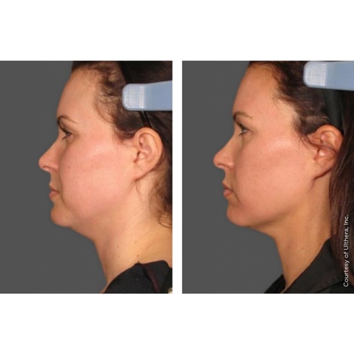 Ultherapy®