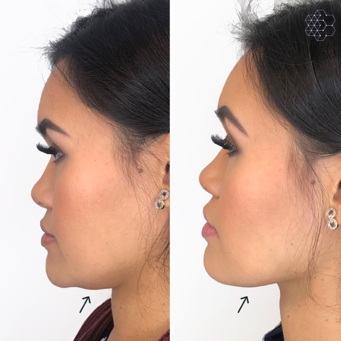 Double Chin Treatment