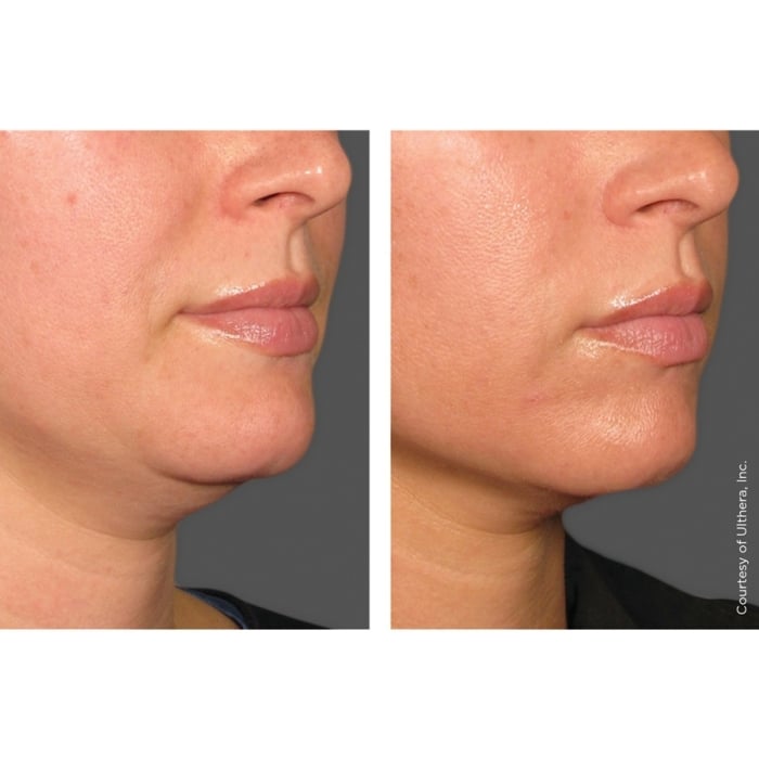 Ultherapy®