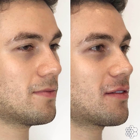 Lip Enhancement