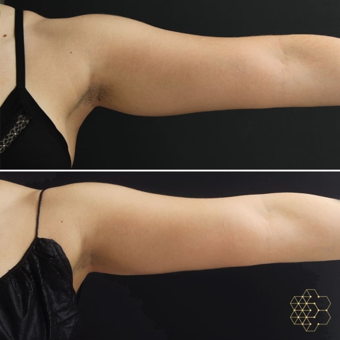 Coolsculpting
