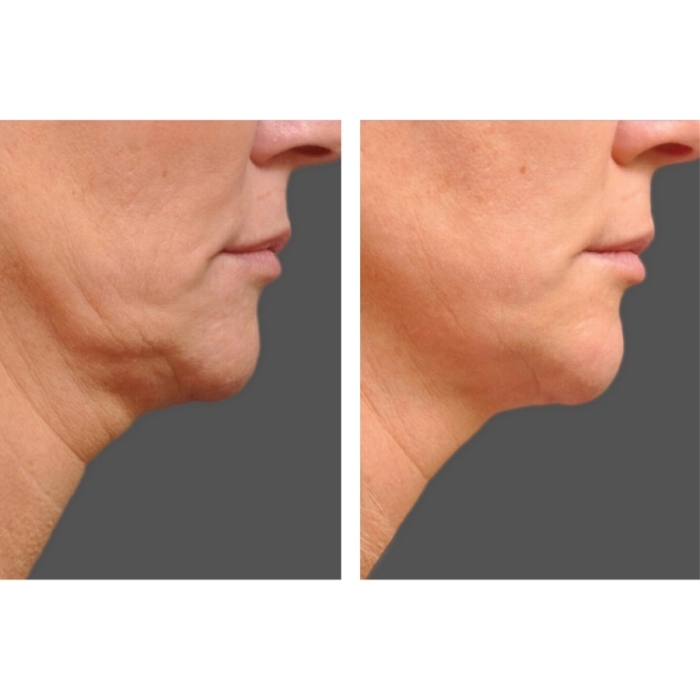 Ultherapy®