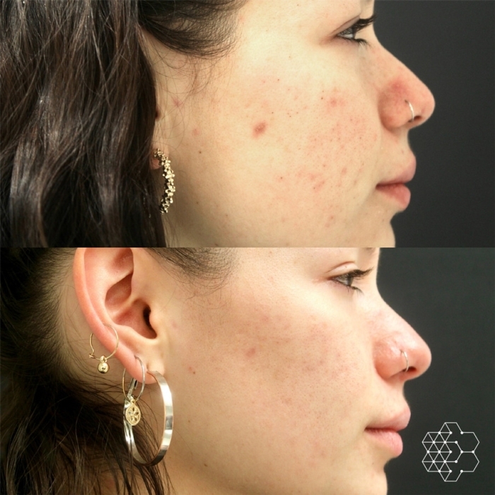Chemical Peel