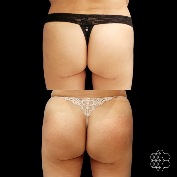 Sculptra Buttocks Enhancement