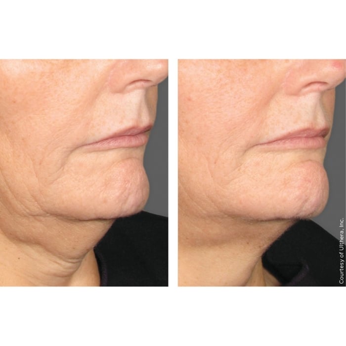 Ultherapy®
