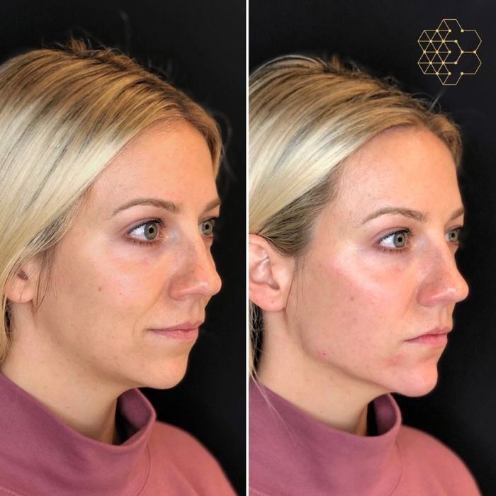 Chin Enhancement