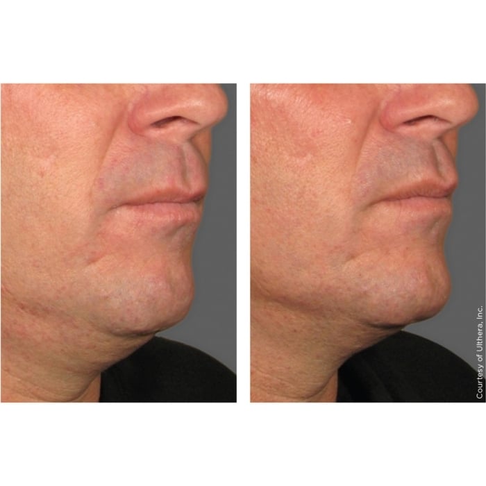 Ultherapy®