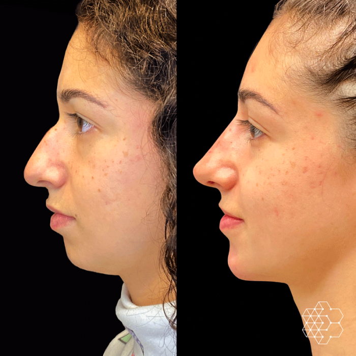 Chin Enhancement
