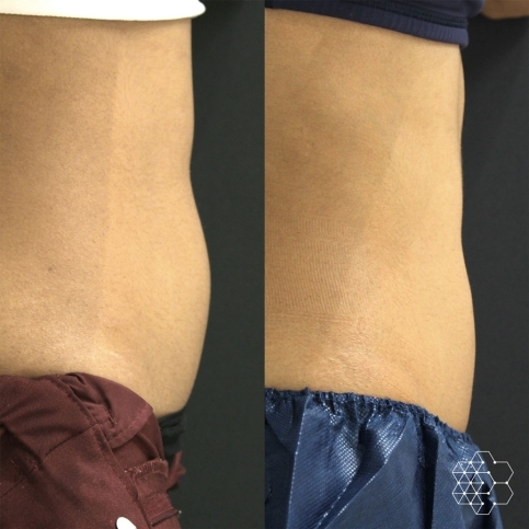 Emsculpt